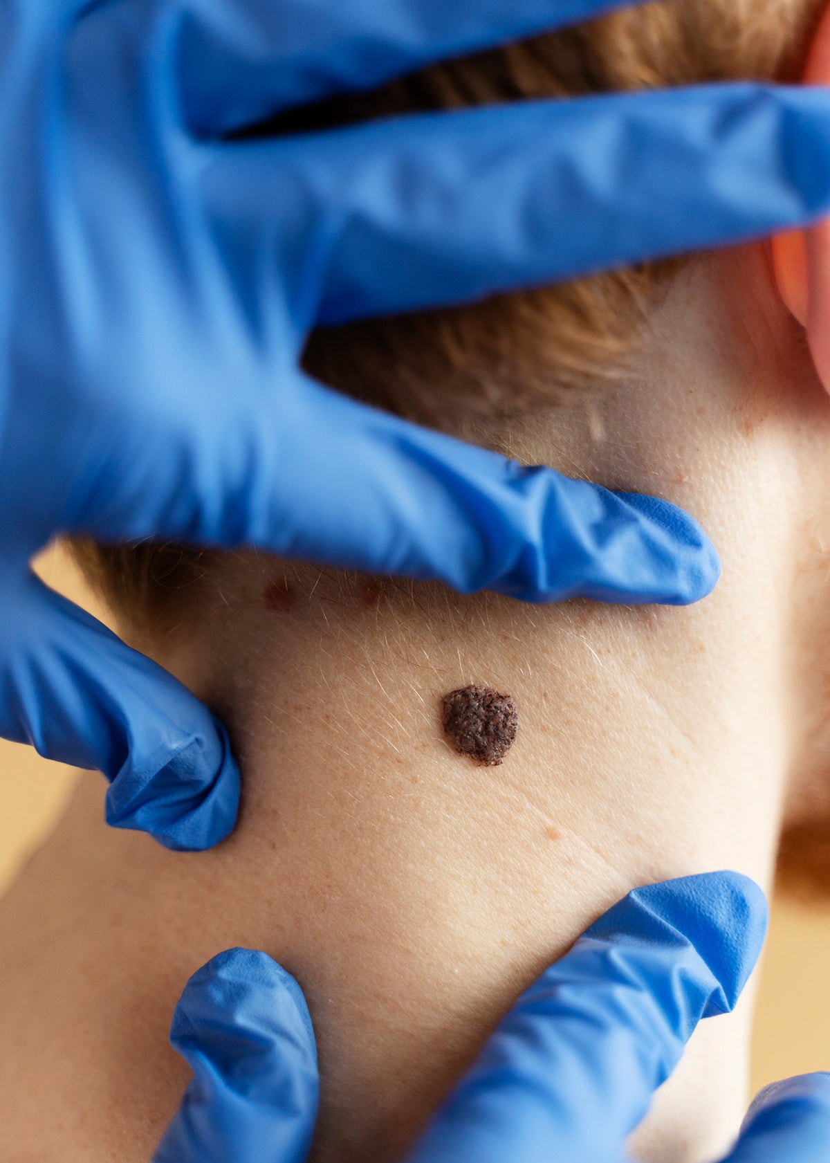 Mole, skin tag and wart removal in Melbourne