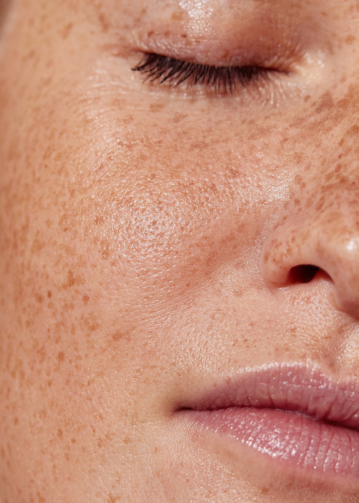 Pigmentation treatment for even skin tone in Melbourne